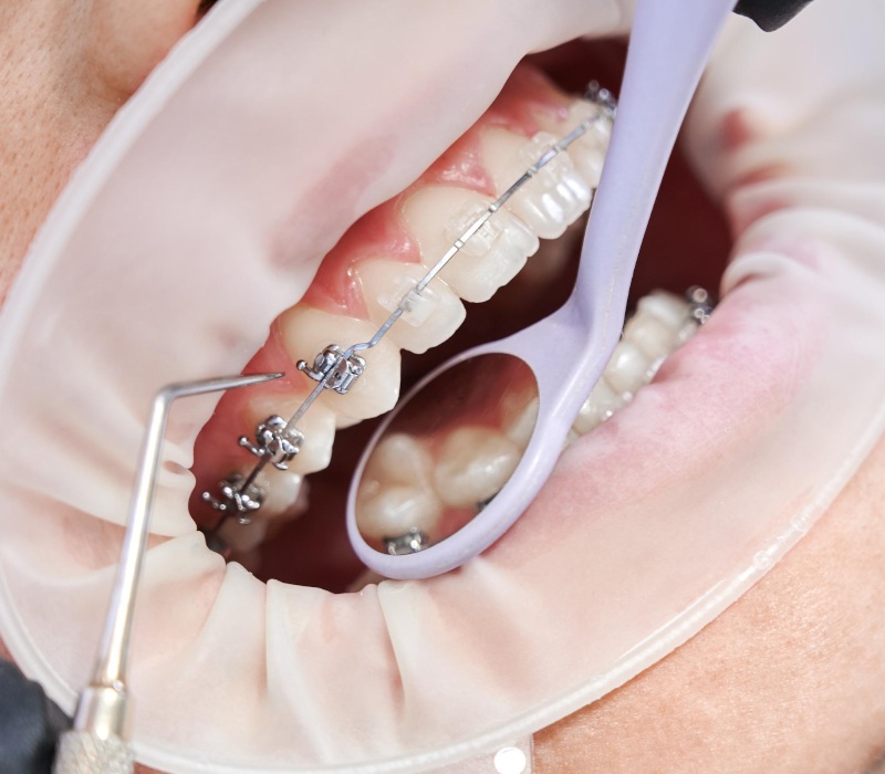 Orthodontists/ Braces on patient teeth