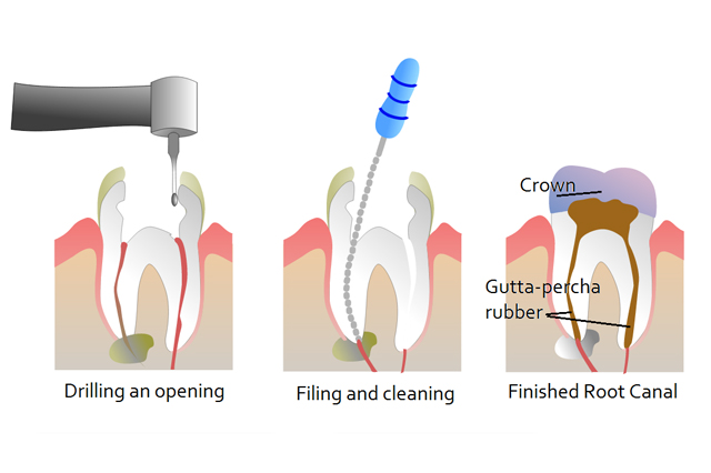 Root Canal